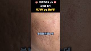 패인 여드름 흉터, 레이저보다 중요한 서브시전 원리: 큐어젯 vs 미라젯 비교