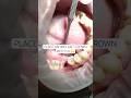 How It S Done Placing An Implant Crown Newsmile Dentalimplant Implant Compositeveneer
