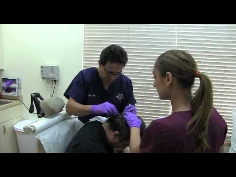 Hair Transplant Suture Removal 2 weeks After Procedure