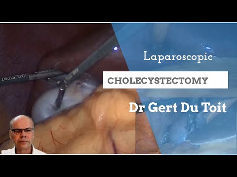 Laparoscopic Cholecystectomy, a tale of 3 Gallbladders