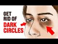 What Causes Dark Circles Under Eyes Dr Berg