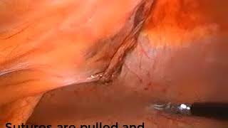 Laparoscopic Paraumbilical hernia repair with mesh fixation