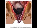 Umbilical Cord Prolapse