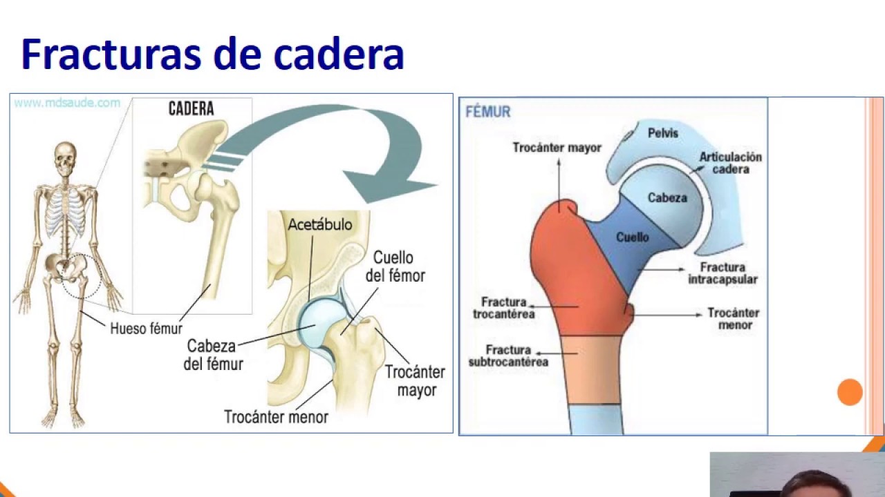 fracturas de cadera