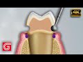 How To Prepare Teeth For Crown And Bridge By Michael DiTolla DDS FAGD