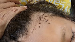 Head lice removing from brown hair - How to clear out all head lice