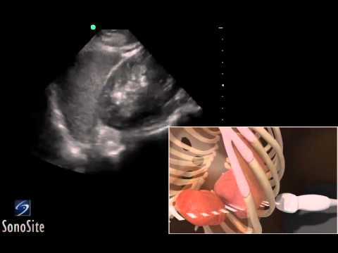 How To: EFAST - LUQ (Left Upper Quadrant) 3D Video
