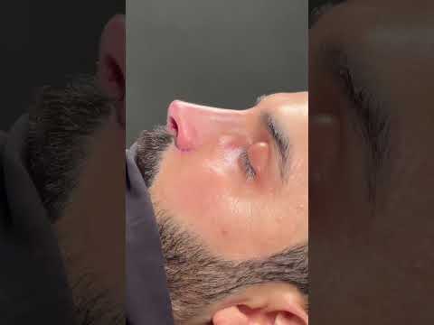 Male Rhinoplasty Before and After Photos in Turkey #nosejob