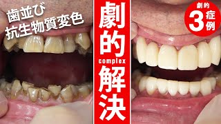 【セラミック矯正】抗生物質で歯が変色…　→　コンプレックスを一瞬で解消！サムネイル