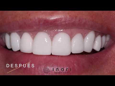 Carillas Dentales de Porcelana