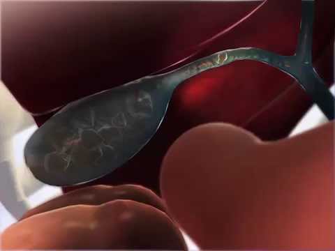 Learn@Visible Body - Gallstones