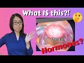 Everything HYSTERECTOMY Gynecologist Answers All Your Questions