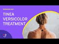 How To Treat Tinea Versicolor?