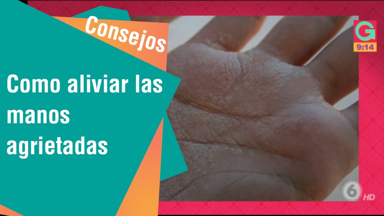 Watch Aliviar las manos agrietadas | Consejos para usted Now Aliviar las manos agrietadas | Consejos para usted