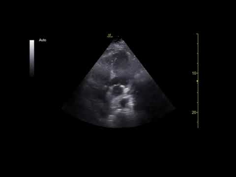 Point of Care Echocardiography of Massive Pulmonary Embolism Prior to Systemic Thrombolysis