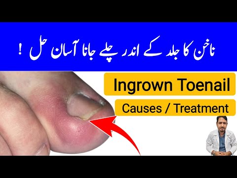Ingrown Toenail Treatment In Urdu Hindi - Irfan Azeem