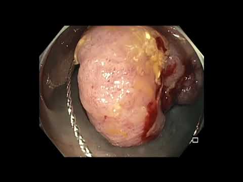 Colonoscopy: Transverse Colon - Giant Polyp Resection