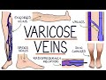 Understanding Varicose Veins