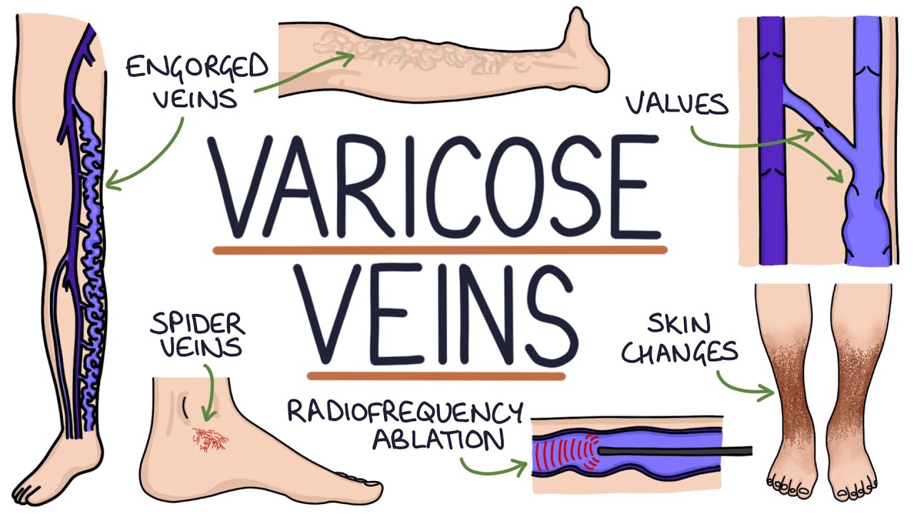 Understanding Varicose Veins