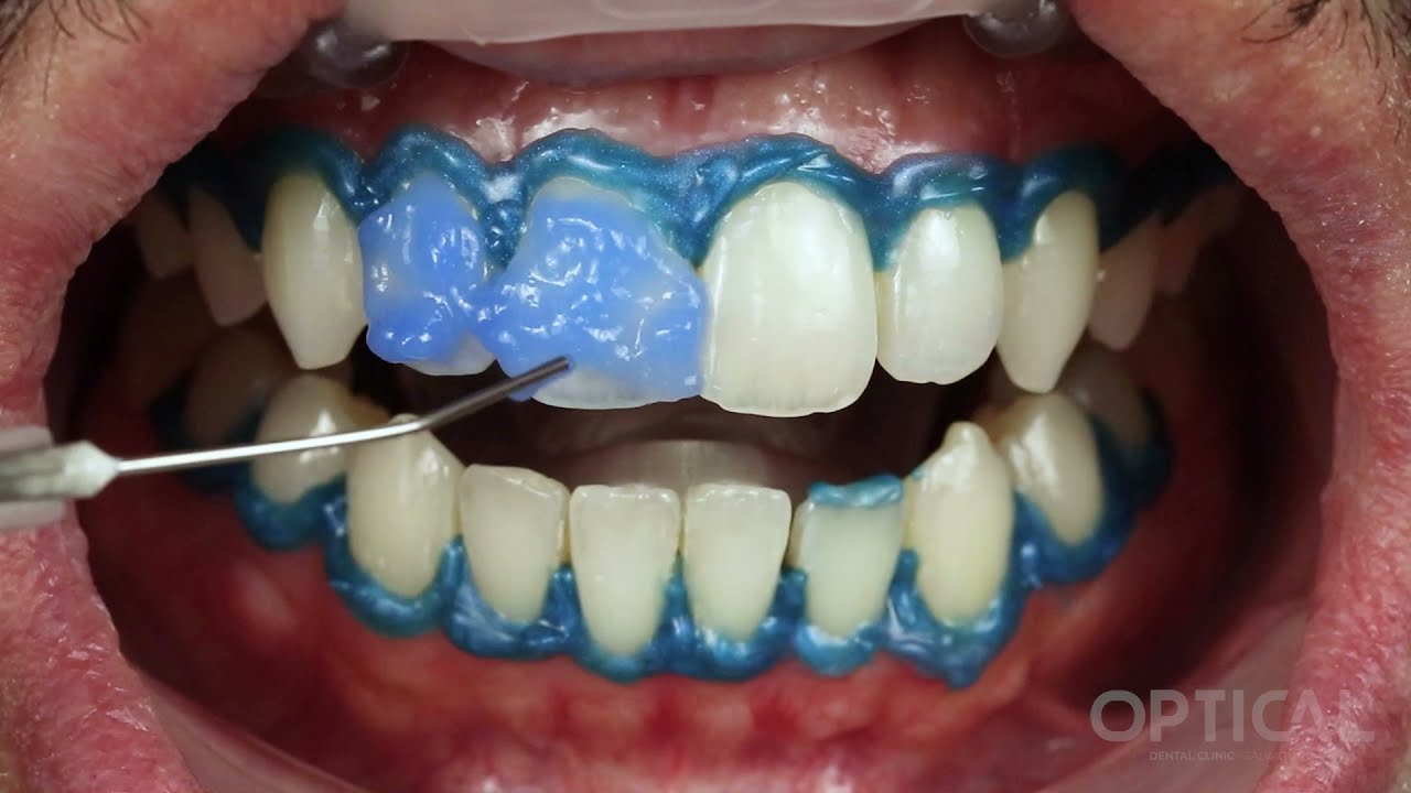 Protocolo de aplicação Potenza Bianco Pro H₂O₂ SS 38%