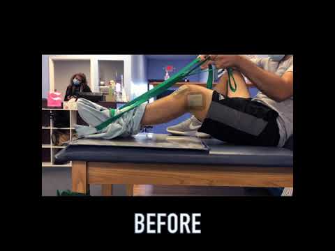 Fractured Femur Progress