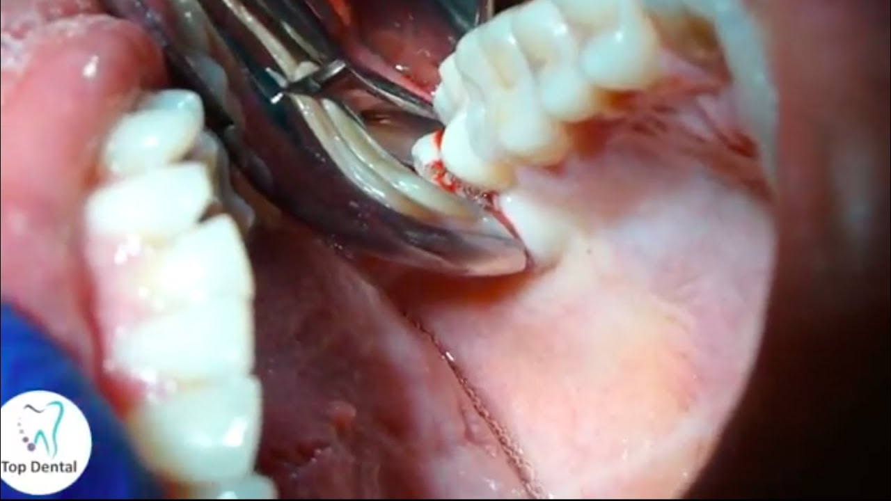 Descubre cómo se hace una extracción de muela en Top Dental