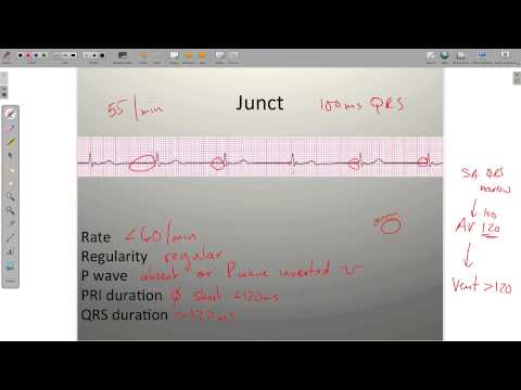 ECG Junctional Rhythms
