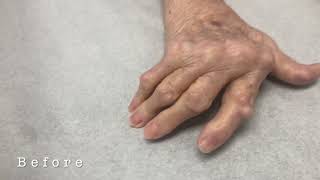 Rheumatoid Hand Deformity Update 3 Months after Surgery
