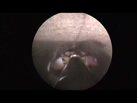 Minimally Invasive Endoscopic Zenker's Diverticulotomy