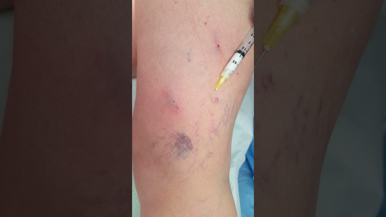 Foam injection sclerotherapye varicose veins