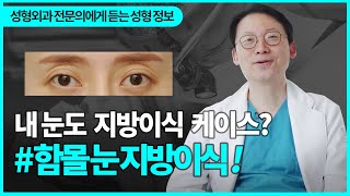 함몰눈,눈지방이식 누가/언제 해야할까?