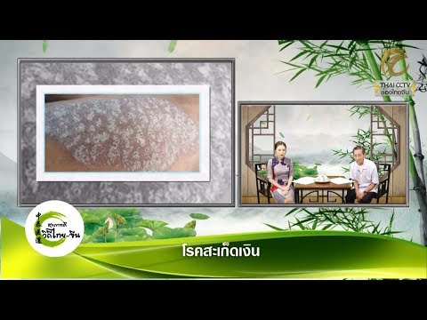 รักษากลากน้ำมันดิน การรักษาเปลวไฟของอาหารโรคสะเก็ดเงิน