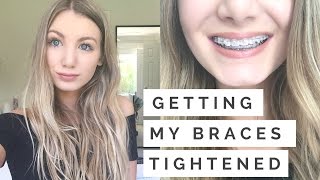 Getting My Braces Tightened For The First Time! | 1 MONTH UPDATE