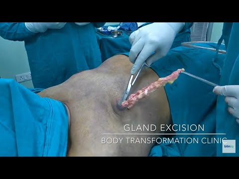 Patient Recovery Case — Video 11 (Tummy Tuck)