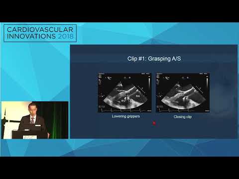 CVI2018 Session: A difficult case of tricuspid therapy - Gilbert Tang, MD