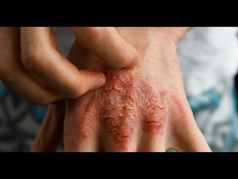 Entenda o que é psoríase e dermatite atópica