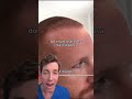 The Hair Transplant Timeline What To Expect
