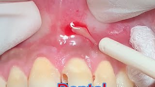 Dental Abscess Drainage