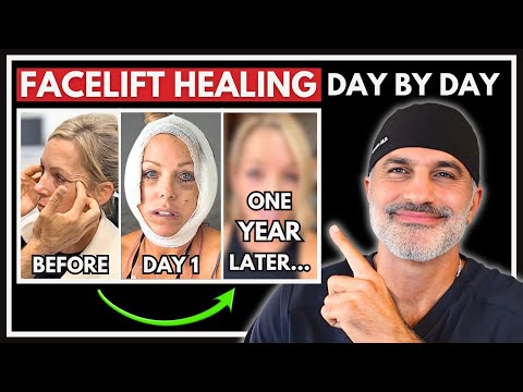 Her Facelift Healing Day by Day: Debbie's Vertical Restore Recovery (FULL with 1-Year Updates!)