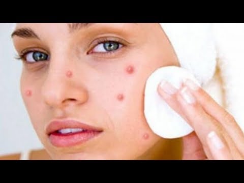 download lagu mp3 mp4 Cara Menghilangkan Jerawat Akibat Cream Pemutih, download lagu Cara Menghilangkan Jerawat Akibat Cream Pemutih gratis, unduh video klip Cara Menghilangkan Jerawat Akibat Cream Pemutih