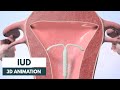 How Does An IUD Work 3D Animation