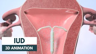 How does an IUD work? | 3D animation