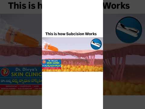 Subcision for deep acne scars - lift up up ur scars immediately