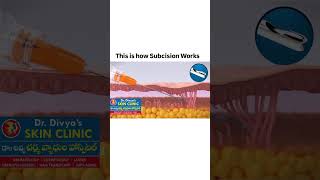 Subcision for deep acne scars - lift up up ur scars immediately