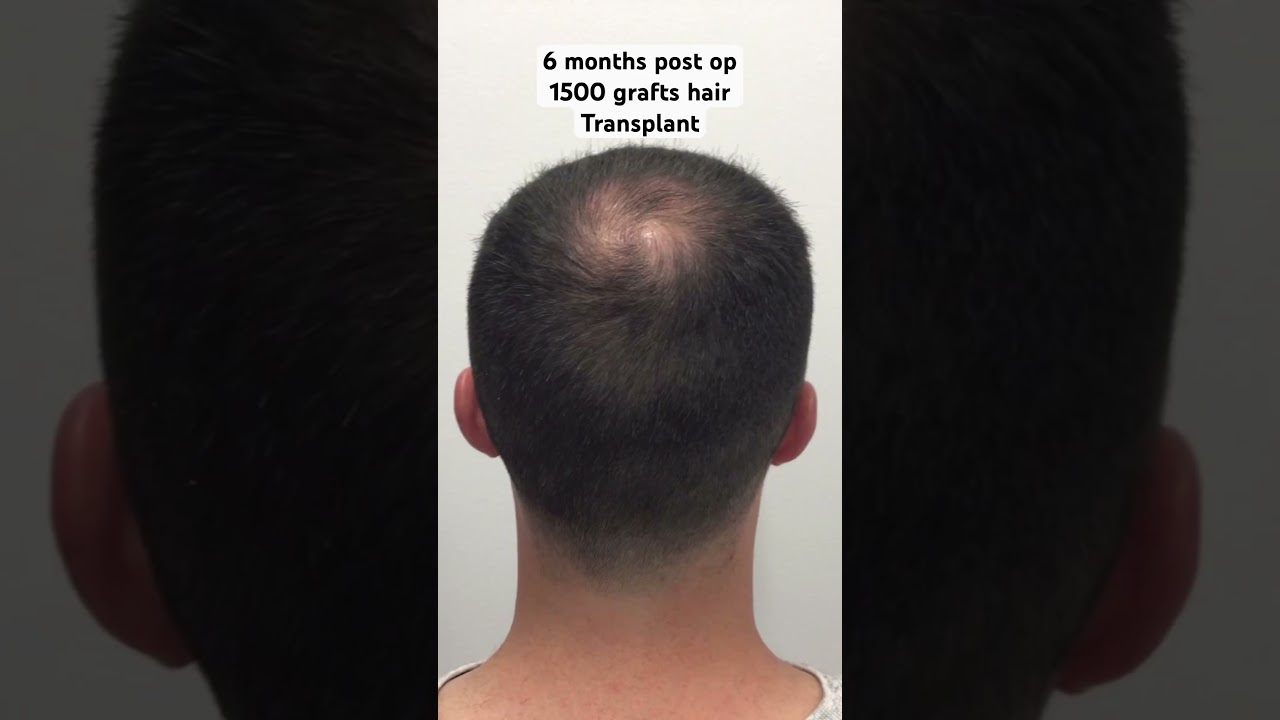 A lot changes in 6 months || Austin, TX Hair Transplant