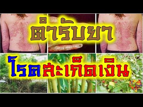ครีมจากการบาดเจ็บหลังจากกลาก โรคสะเก็ดเงินไม่ว่าจะเป็นการส่ง