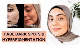HOW TO FADE DARK SPOTS ON FACE FAST | Fade Hyperpigmentation & Acne Marks Products | Razia Moe