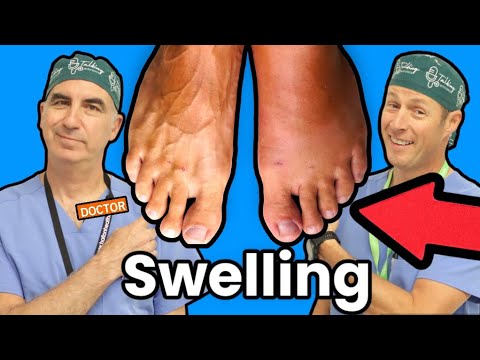 Foot and Ankle Swelling: What Causes It?