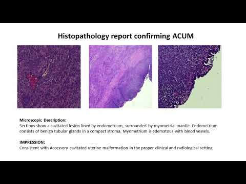 Robotic Excision of an ACUM