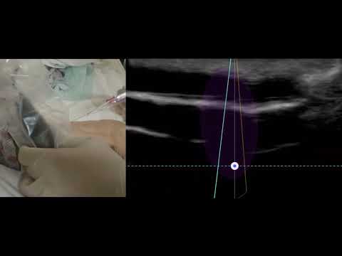 Ultrasound Guided IV Insertion #powerglide #vascularaccess #doctor #nurse #ultrasoundiv #ernurse